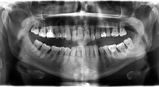enfermedad periodontal crónica