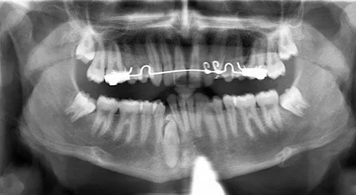 odontoma